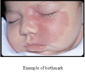 Example of Birthmark